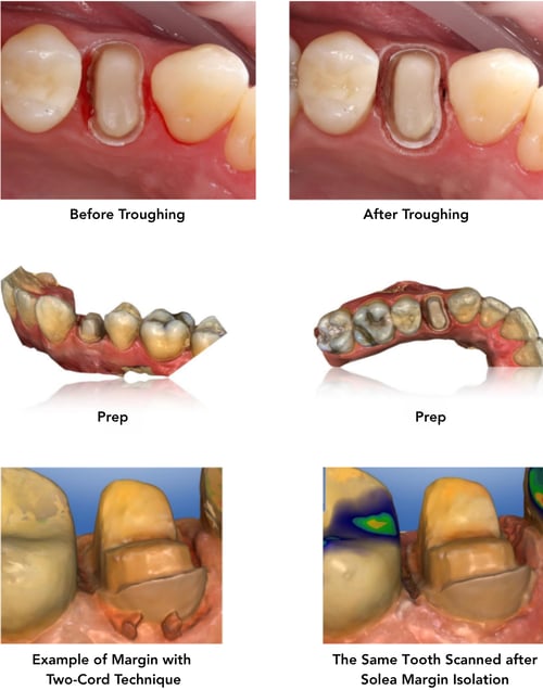 Dr. Anderson Clinical Case Images-Troughing