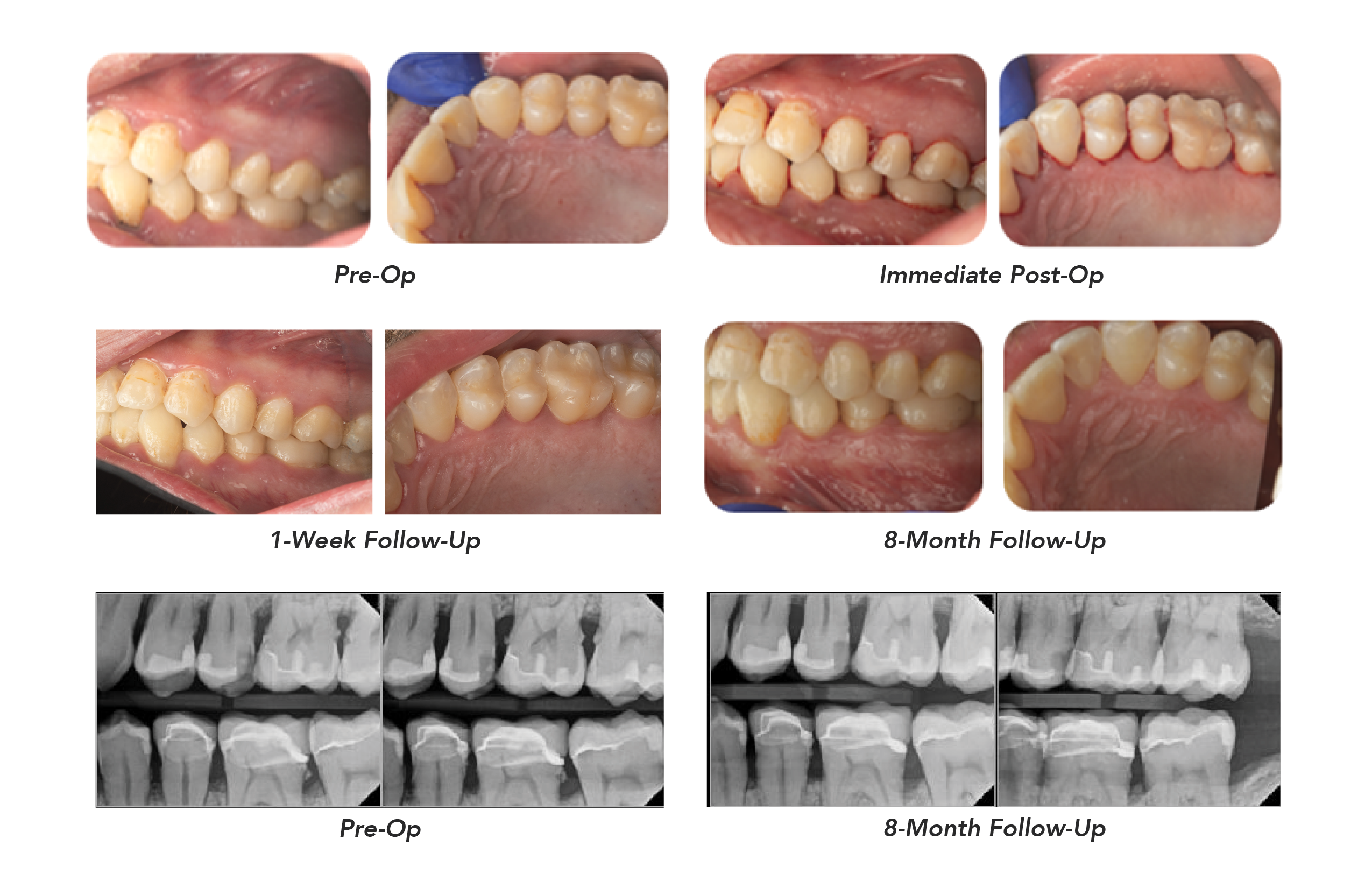 Periodontitis Patient Photos X-Rays Before and After Solea Perioguide Treatment