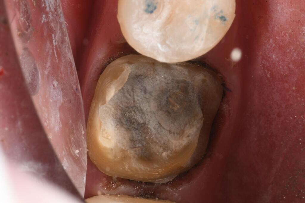 Post caries removal and Solea decontamination. Image courtesy of Robin J. Henderson, DDS.