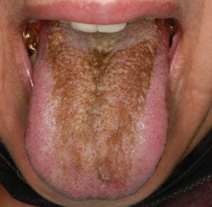 A Novel Approach to Treating Hairy Tongue 1