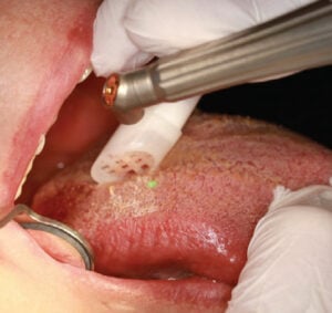 A Novel Approach to Treating Hairy Tongue 2