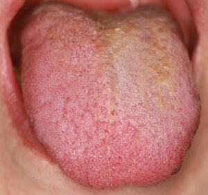 A Novel Approach to Treating Hairy Tongue 3