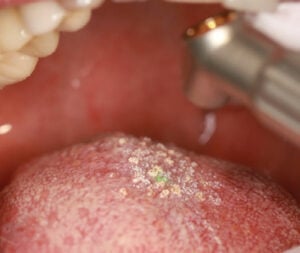 A Novel Approach to Treating Hairy Tongue 4