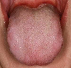 A Novel Approach to Treating Hairy Tongue 5