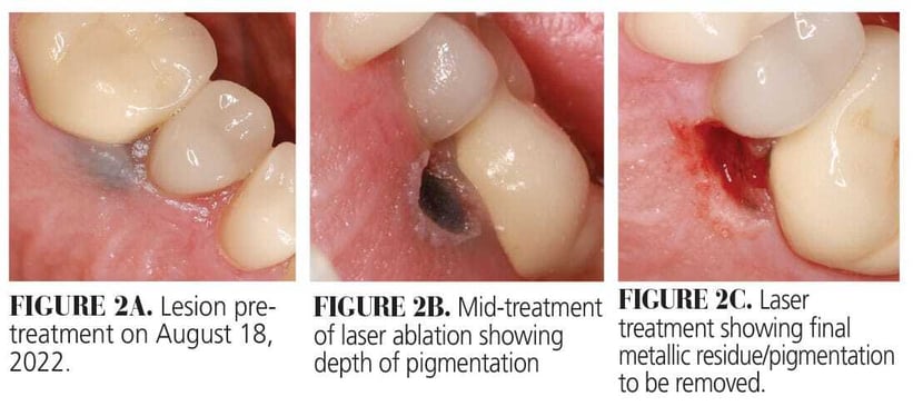 Use of Laser Therapy in Amalgam Tattoo Removal Figure 2A-2B-2C