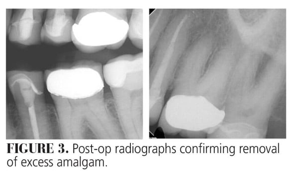 Use of Laser Therapy in Amalgam Tattoo Removal Figure 3