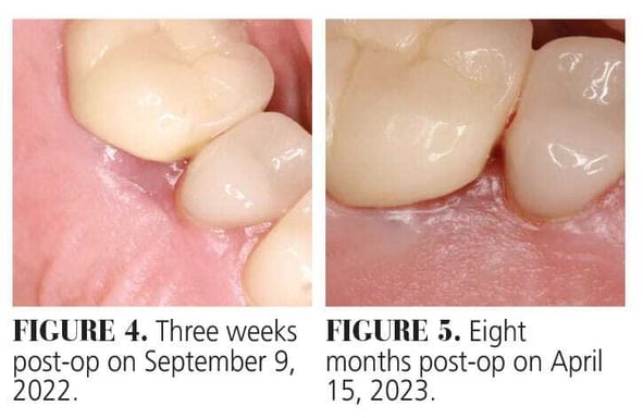Use of Laser Therapy in Amalgam Tattoo Removal Figure 4 and 5
