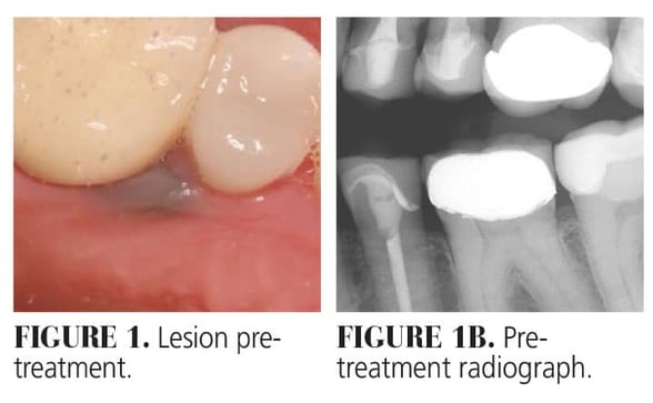 Use of Laser Therapy in Amalgam Tattoo Removal_Figure 1 and 1B