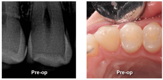 Anesthesia-Free Class II Restoration: Pre-Op