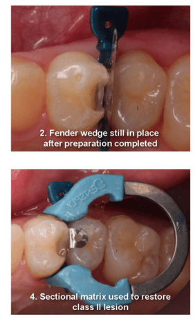 Anesthesia-Free Class II Restoration: Cavity Prep