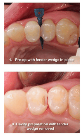 Anesthesia-Free Class II Restoration: Cavity Prep