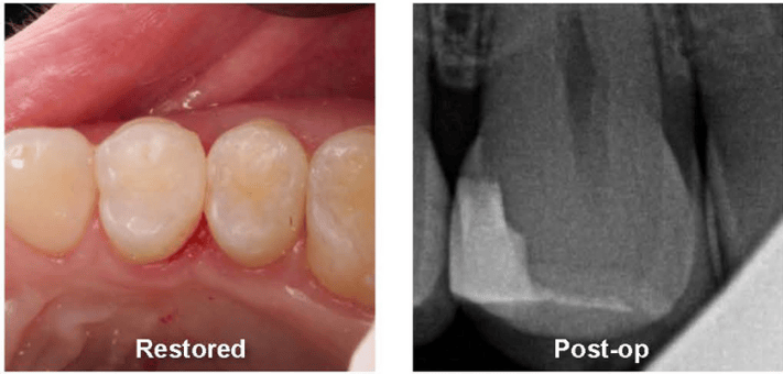 Anesthesia-Free Class II Restoration:Results