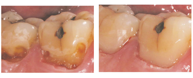 CaseStudy1-Combined-2018-07-31 | Left: Tooth pre-op with deep decay. Right: Tooth immediately post-op after treatment with Solea. 