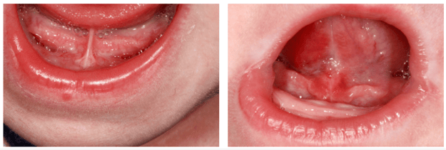 CaseStudy2-Combined-2018-07-31 | Left: Class I tongue-tie pre-op. Right: 10 days post-op after treatment with Solea
