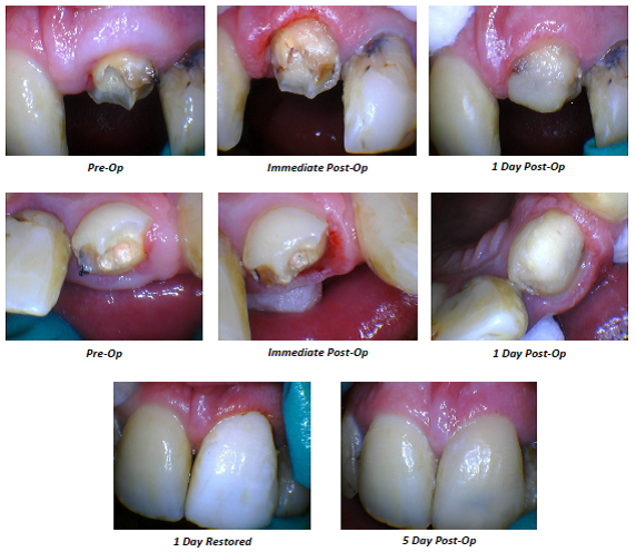 Gingivectomy #9 img