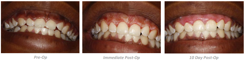 Gingivectomy-Depigmentation img