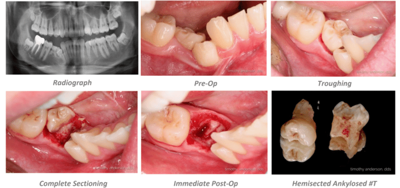 Ankylosed Tooth Extraction Case Summary