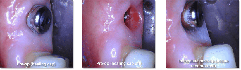 Tissue Recontouring for Implant Restoration 2 Technique Used