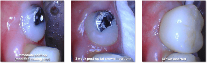 Tissue Recontouring for Implant Restoration 2 Technique Used 2