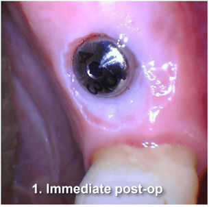 Tissue Recontouring for Implant Restoration Immediate Post-Op