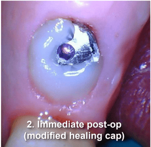 Tissue Recontouring for Implant Restoration Immediate Post-Op with Healing Cap
