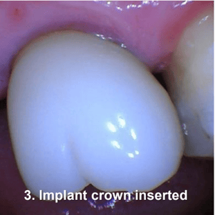 Tissue Recontouring for Implant Restoration Implant Crown Inserted 