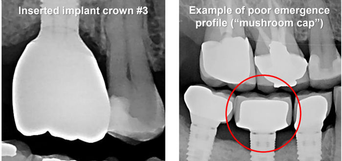 Tissue Recontouring for Implant Restoration Results