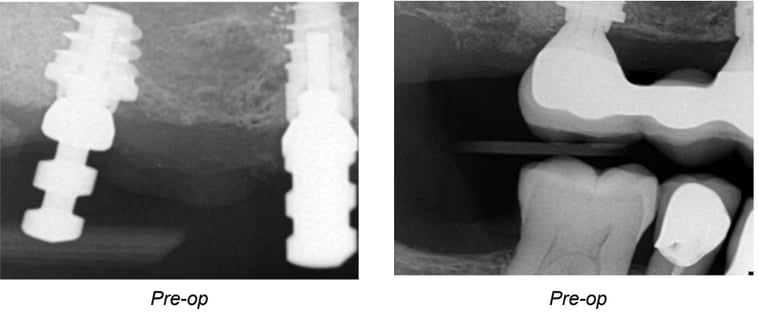 Repair of Osseous Defect on Implant #5 Secondary to Occlusal Overload Pre-Op