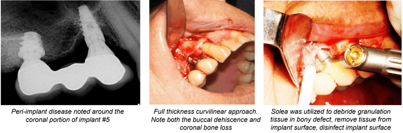 Repair of Osseous Defect on Implant #5 Secondary to Occlusal Overload Technique Used