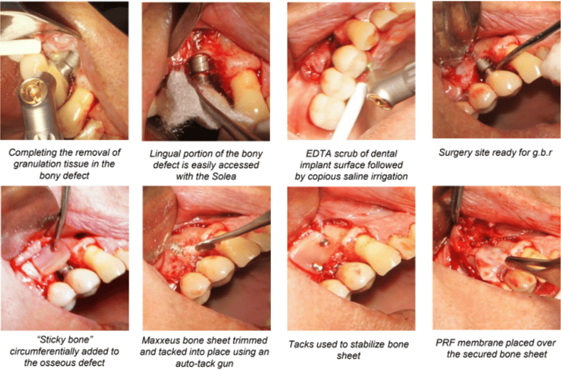Repair of Osseous Defect on Implant #5 Secondary to Occlusal Overload Technique Used 2
