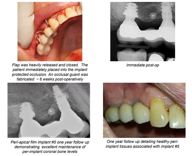 Repair of Osseous Defect on Implant #5 Secondary to Occlusal Overload Results