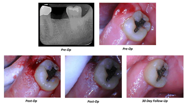 Ultraguide Periodontal Abscess Case Summary