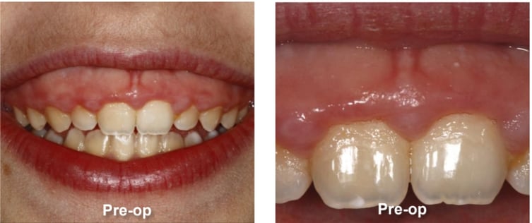 Gingivectomy and Maxillary Frenectomy Pre-Op