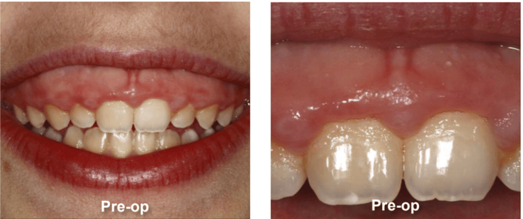Gingivectomy and Maxillary Frenectomy Pre-Op
