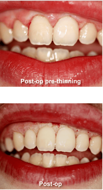 Gingivectomy and Maxillary Frenectomy Pre-Op Thinning and Post-Op