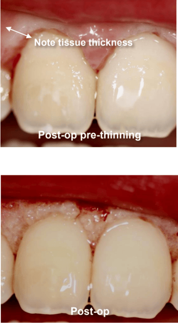 Gingivectomy and Maxillary Frenectomy Post-Op Pre-Thinning and Post-Op