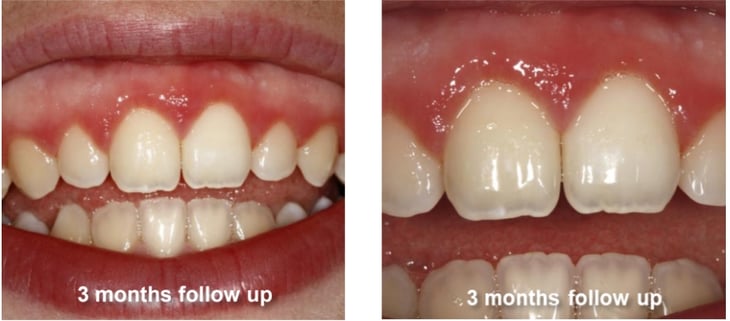 Gingivectomy and Maxillary Frenectomy  Follow-Up