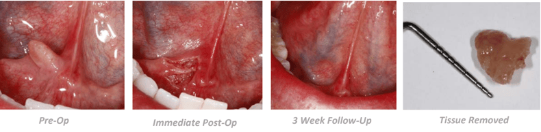 Mucocele Removal Case Summary
