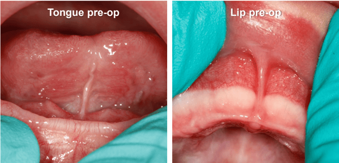 Infant Lingual and Maxillary Frenectomies Pre-Op