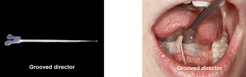Infant Lingual and Maxillary Frenectomies Technique Used