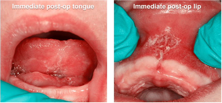 Infant Lingual and Maxillary Frenectomies Results
