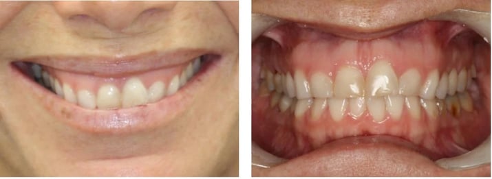 Anterior CEREC Veneers with Esthetic Crown Lengthening Using Solea Summary