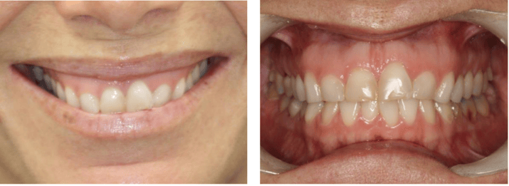 Anterior CEREC Veneers with Esthetic Crown Lengthening Using Solea Summary