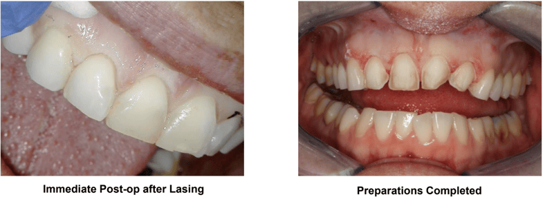 Anterior CEREC Veneers with Esthetic Crown Lengthening Using Solea Technique Used
