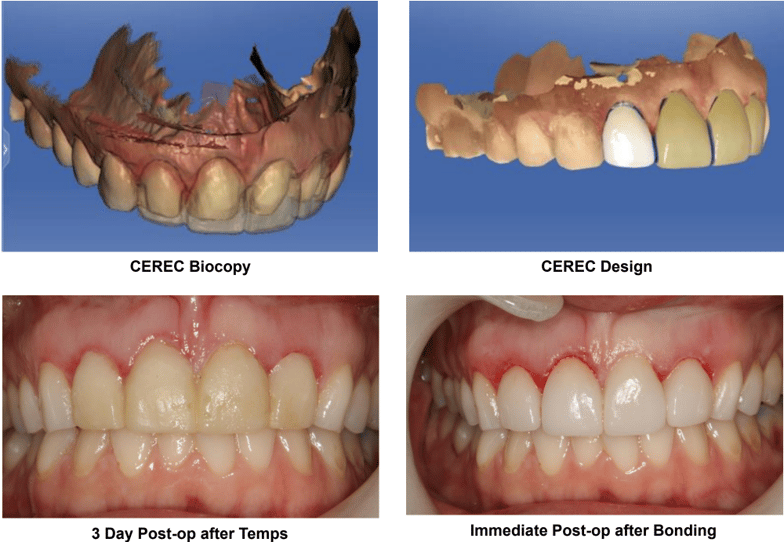 Anterior CEREC Veneers with Esthetic Crown Lengthening Using Solea Technique Used 2