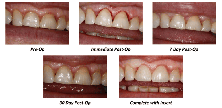 Crown Lengthening #8 and #9 (Closed) Case Summary