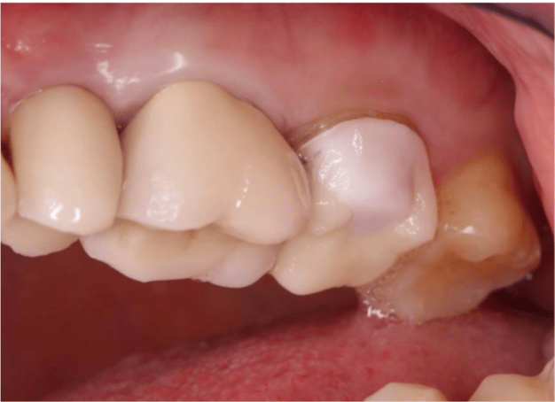 Porcelain Fused to Zirconia Crown Removal Case Summary