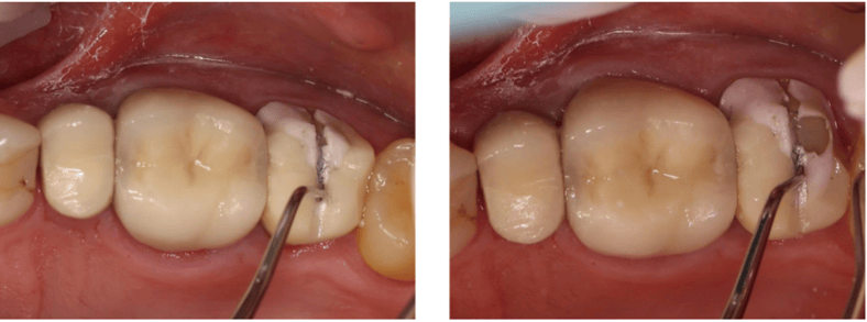 Porcelain Fused to Zirconia Crown Removal Technique Used