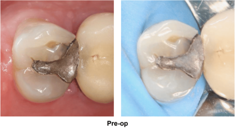 Deep Class II Restoration on Tooth #12 DO Pre-Op