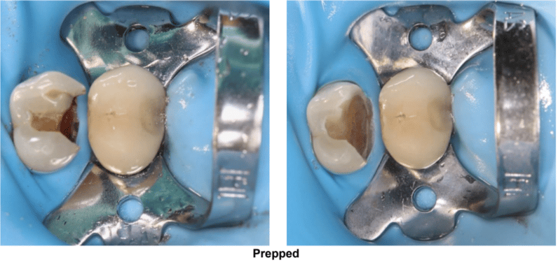 Deep Class II Restoration on Tooth #12 DO Prepped